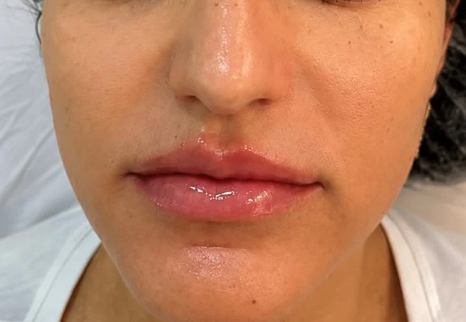 Depois do tratamento Firm e Lyft com Botox Full Face
